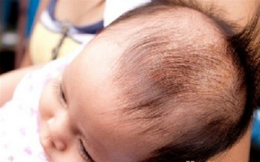 Hiện tượng cứt trâu phổ biến ở trẻ sơ sinh