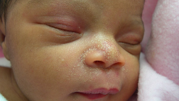 Dễ dàng nhận biết cứt trâu ở trẻ sơ sinh qua những mảng bám dày đặc trên da đầu bé