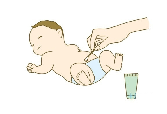 Vệ sinh bé không sạch sẽ là một trong những nguyên nhân chính gây nhiễm trùng rốn